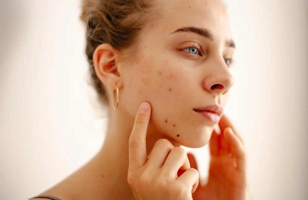 jakie suplementy na trądzik